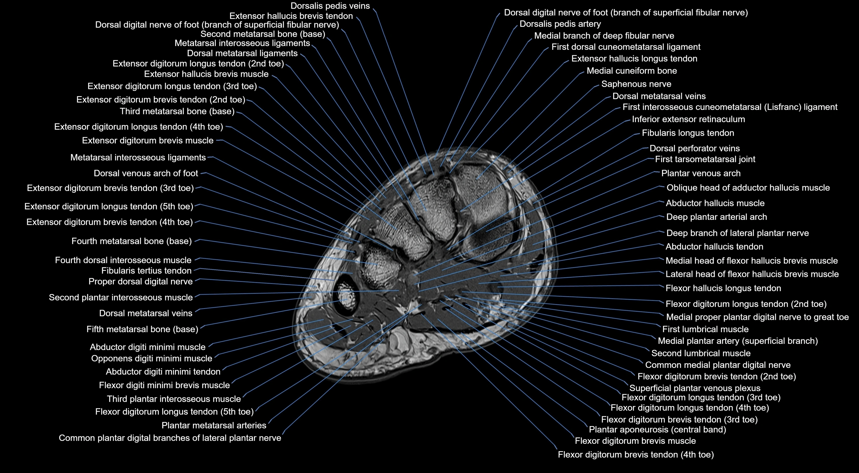 MRI mid foot coronal ligaments cross sectional anatomy 3T  radiology  image-img-00001-00014.webp
